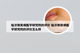 临沂银屑病医学研究院的评价 临沂银屑病医学研究院的评价怎么样