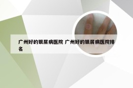 广州好的银屑病医院 广州好的银屑病医院排名