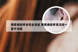 银屑病皮疹会完全消退 银屑病皮疹变淡但一直不消退