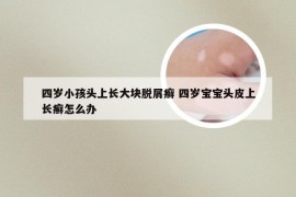 四岁小孩头上长大块脱屑癣 四岁宝宝头皮上长癣怎么办