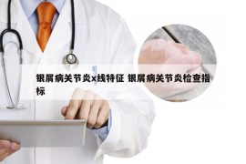 银屑病关节炎x线特征 银屑病关节炎检查指标