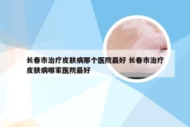 长春市治疗皮肤病那个医院最好 长春市治疗皮肤病哪家医院最好