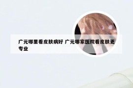 广元哪里看皮肤病好 广元哪家医院看皮肤更专业