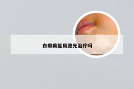 白癫疯能用激光治疗吗