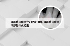 银屑病住院治疗14天的效果 银屑病住院治疗都做什么检查