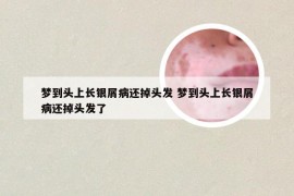 梦到头上长银屑病还掉头发 梦到头上长银屑病还掉头发了