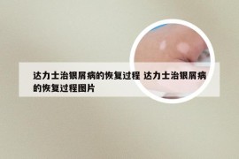 达力士治银屑病的恢复过程 达力士治银屑病的恢复过程图片