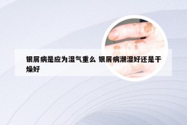 银屑病是应为湿气重么 银屑病潮湿好还是干燥好