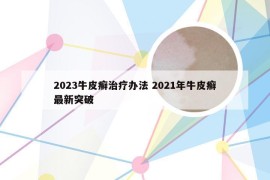 2023牛皮癣治疗办法 2021年牛皮癣最新突破