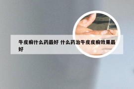 牛皮癣什么药最好 什么药治牛皮皮癣效果最好