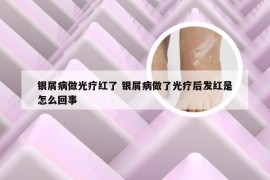 银屑病做光疗红了 银屑病做了光疗后发红是怎么回事