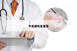 牛皮癣吃鱼复发