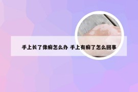 手上长了像癣怎么办 手上有癣了怎么回事