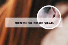 白斑病传不传染 白斑病会传染人吗