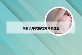 为什么牛皮癣吃黄芪会加重