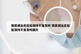 银屑病治愈后能保持不复发吗 银屑病治愈后能保持不复发吗图片