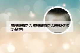 银屑病照紫外光 银屑病照紫外光要照多少次才会好呢