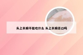 头上长癣不能吃什么 头上长癣忌口吗