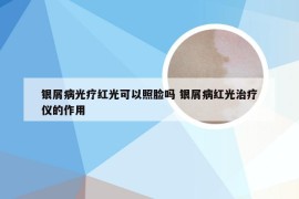 银屑病光疗红光可以照脸吗 银屑病红光治疗仪的作用