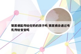 银屑病能传给吃奶的孩子吗 银屑病会通过母乳传给宝宝吗