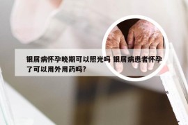 银屑病怀孕晚期可以照光吗 银屑病患者怀孕了可以用外用药吗?