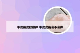 牛皮癣皮肤瘙痒 牛皮皮癣会不会痒