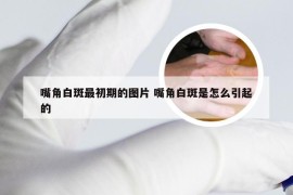 嘴角白斑最初期的图片 嘴角白斑是怎么引起的