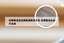 白蒺藜泡浴治银屑病用多少克 白蒺藜泡水治疗白斑