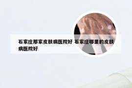 石家庄那家皮肤病医院好 石家庄哪里的皮肤病医院好