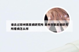 谁去过郑州银屑病研究所 郑州市银屑病研究所看病怎么样