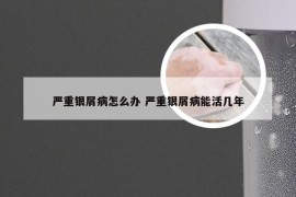 严重银屑病怎么办 严重银屑病能活几年