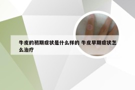 牛皮的初期症状是什么样的 牛皮早期症状怎么治疗