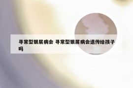 寻常型银屑病会 寻常型银屑病会遗传给孩子吗