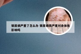 银屑病严重了怎么办 银屑病很严重对身体有影响吗