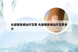 头部银屑病治疗花费 头部银屑病治疗花费多少