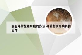 治愈寻常型银屑病的办法 寻常型银屑病药物治疗