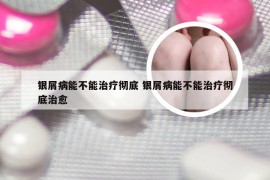 银屑病能不能治疗彻底 银屑病能不能治疗彻底治愈