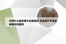 天津什么医院看牛皮癣症好 天津治疗牛皮肤癣最好的医院