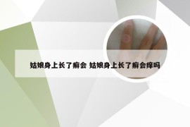 姑娘身上长了癣会 姑娘身上长了癣会痒吗