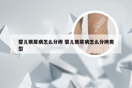 婴儿银屑病怎么分辨 婴儿银屑病怎么分辨类型