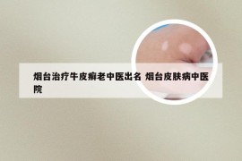 烟台治疗牛皮癣老中医出名 烟台皮肤病中医院