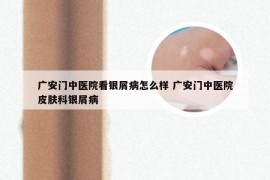 广安门中医院看银屑病怎么样 广安门中医院皮肤科银屑病
