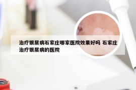 治疗银屑病石家庄哪家医院效果好吗 石家庄治疗银屑病的医院