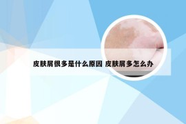 皮肤屑很多是什么原因 皮肤屑多怎么办