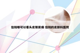 信阳哪可以看头皮银屑病 信阳的皮肤科医院
