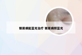 银屑病能蓝光治疗 银屑病照蓝光