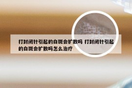 打封闭针引起的白斑会扩散吗 打封闭针引起的白斑会扩散吗怎么治疗
