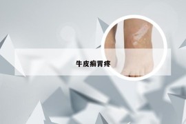 牛皮癣胃疼