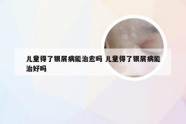 儿童得了银屑病能治愈吗 儿童得了银屑病能治好吗