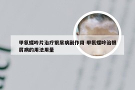 甲氨蝶呤片治疗银屑病副作用 甲氨蝶呤治银屑病的用法用量